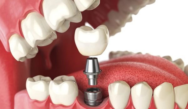 69011eeb4013446c6b3fd309_implante-dentario-preco